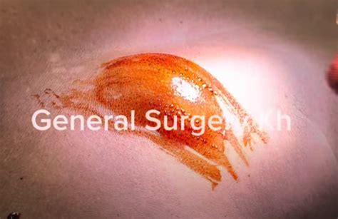 Image result for Explosive Back Cysts