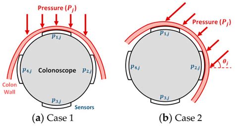 A Pressure Sensing Device to Assist in Colonoscopic Procedures to ...