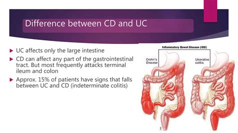 How Does Caffeine Affect Ulcerative Colitis? A Patient’s Guide