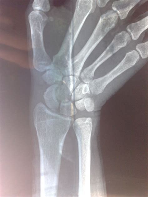 右手手腕骨骼正常吗，求专业人士。不胜感激_百度知道