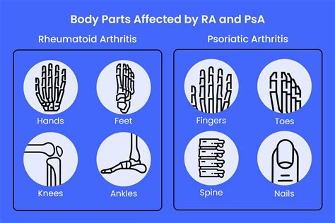 Psoriatic Arthritis vs Rheumatoid Arthritis: Key Differences Explained