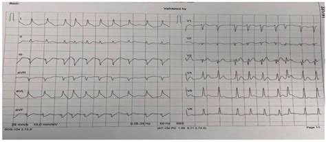 Simultaneous Double-Vessel Coronary Thrombosis with Sudden Cardiac ...