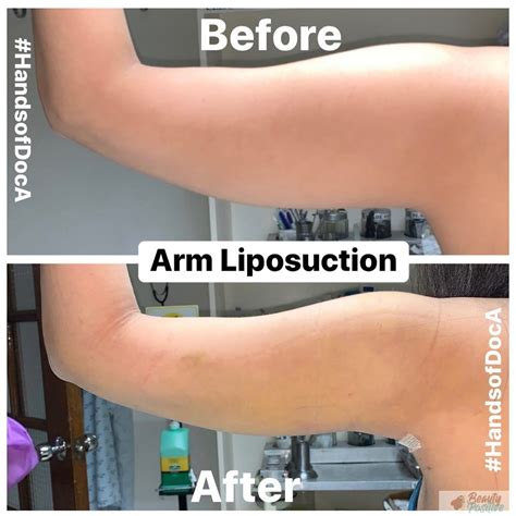 Body Jet Liposuction Cost at Jon Lefebre blog