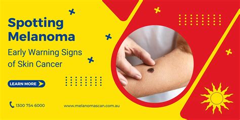 Spotting Melanoma Early Warning Signs