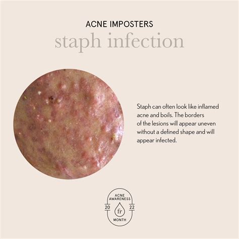 Staph Infection Acne at Florence Turner blog