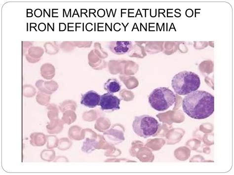 Microcytic hypochromic anemia | PPTX