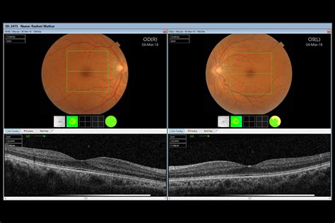 Image result for How to Use the Oct Scan in Optometry