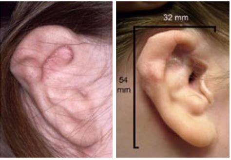 Gallery – The Microtia and Atresia Clinic at Vanderbilt