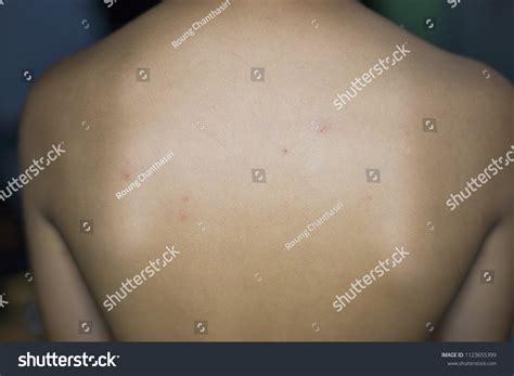 Rash On Skin After Swimming Dirty Stock Photo 1123655399 | Shutterstock