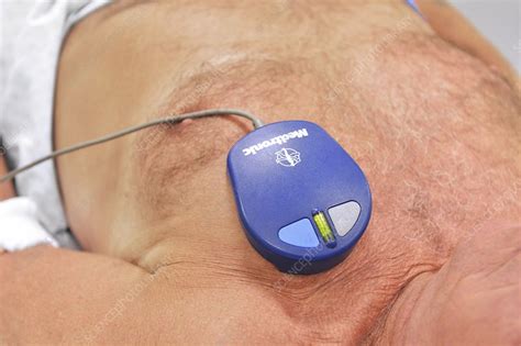 Image result for Merlin Pacemaker Monitor