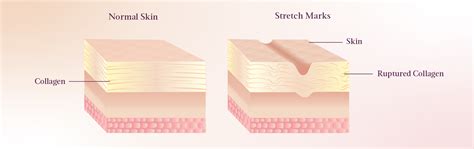 Stretch Marks During Pregnancy: Everything You Should Know – AreoVeda