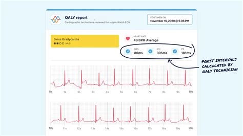 QRS Interval on Your Watch ECG - Narrow, Normal, and Wide | Qaly