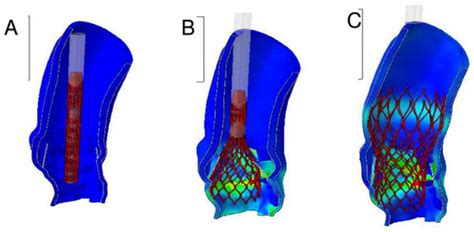 A Finite Element Analysis Study from 3D CT to Predict Transcatheter ...