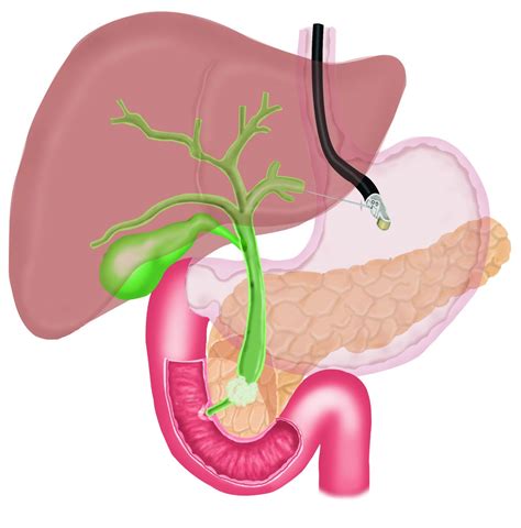 Cholecystojejunostomy Gastrojejunostomy