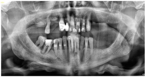 Digital Workflow in Full Mouth Rehabilitation with Immediate Loading ...