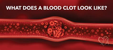Blood Clot Leg Appearance Inside