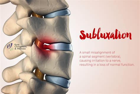What Is Subluxation Of The Lumbar Spine at Fred Morales blog