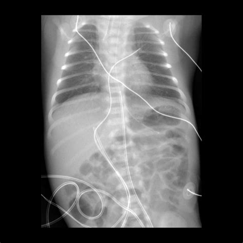 How To Insert Umbilical Venous Catheter at Tayla Currey blog