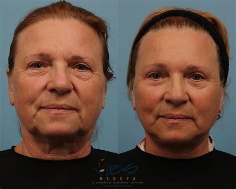 Eyelid Surgery