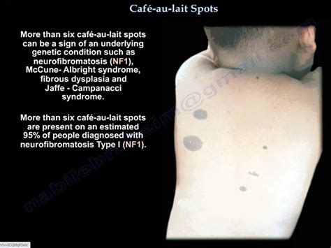 Cafe-au-lait Spots and NeuroCutaneous Markers — OrthopaedicPrinciples.com