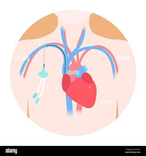 Tunneled central line venous catheter medical diagram Stock Vector Image & Art - Alamy