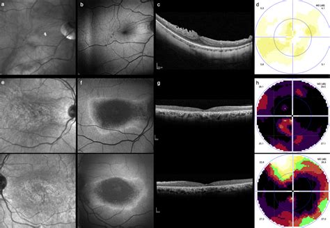 Bull’s Eye Maculopathy in Near-Infrared Reflectance as An Early Sign of ...