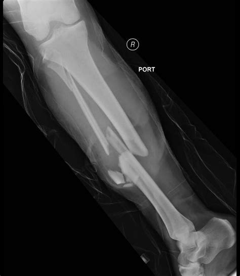 Bilateral Tibia/Fibula Fractures in Automobile versus Pedestrian ...