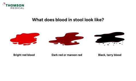 Blood in Stool (Faeces): Causes, Diagnosis, and Treatment | Thomson Medical