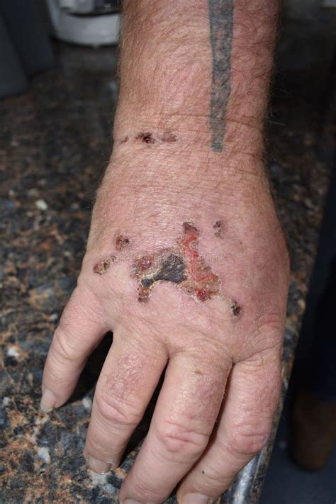 Image result for Exploding Orange Hand Injury