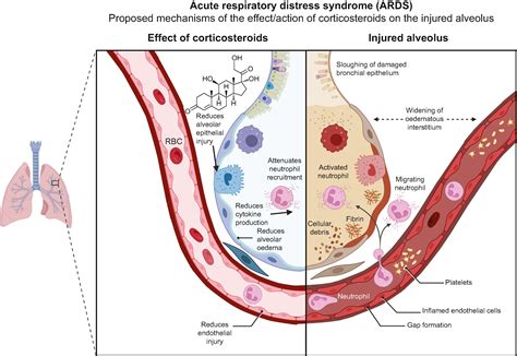 Corticosteroids in adults with acute respiratory distress syndrome and severe pneumonia - BJA ...
