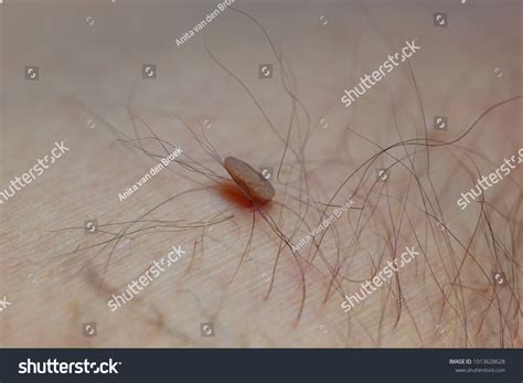 281 Acrochordons Images, Stock Photos & Vectors | Shutterstock