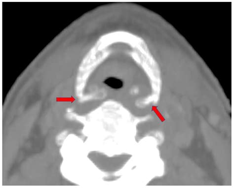 Hyoid Bone Fracture Pattern Assessment in the Forensic Field: The ...