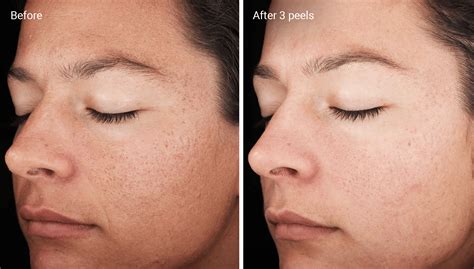 Chemical Peels for Acne Scars: Efficacy, Before and Afters, At-Home Uses
