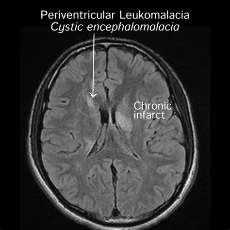 Clinical Pathology Glossary: Periventricular Leukomalacia | ditki medical & biological sciences