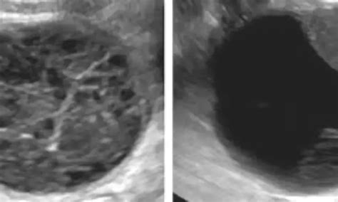 O-RADS MRI has high diagnostic performance for characterizing adnexal ...