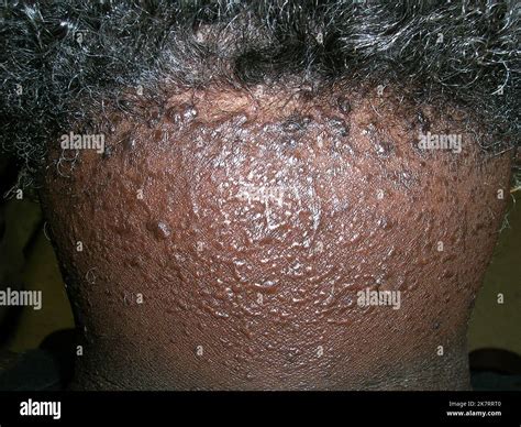 Acne keloidalis nuchae (AKN) in a senior African American male patient. AKN is a type of ...
