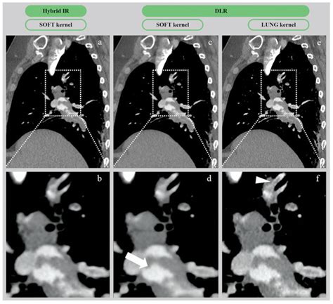 Deep Learning Versus Iterative Reconstruction for CT Pulmonary ...