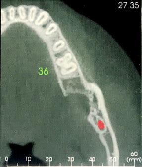 Unusual histological presentation of a residual cyst: A case report ...