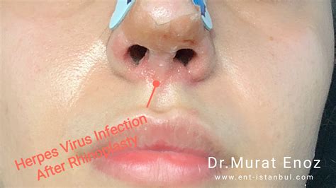 Herpes Infection Before and After Rhinoplasty