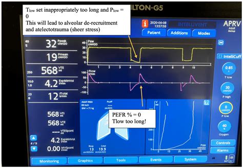 REBEL Crit Cast Ep3.0: Airway Pressure Release Ventilation (APRV) Made Simple - REBEL EM ...