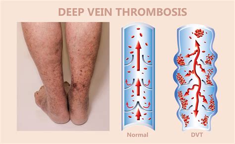How Do You Know If You Have Deep Vein Thrombosis (DVT)? - Vein Specialists of the Carolinas