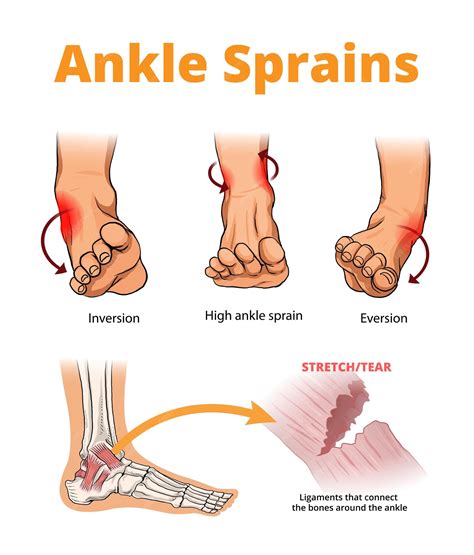 Illustration of ankle sprains types | Premium Vector