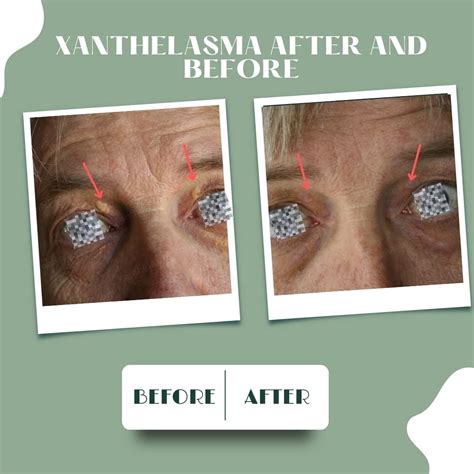 Buy XanthRemover 70% Glycolic Acid Peel Gel Improves The Appearance of ...