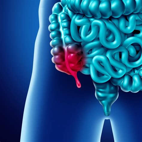 Causes and Treatment of Appendicitis - Facty Health