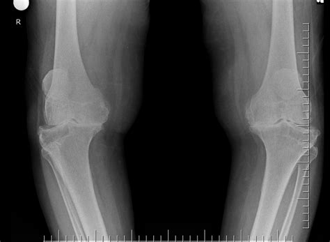 Knee extensor power is related to mobility in osteoarthritis.
