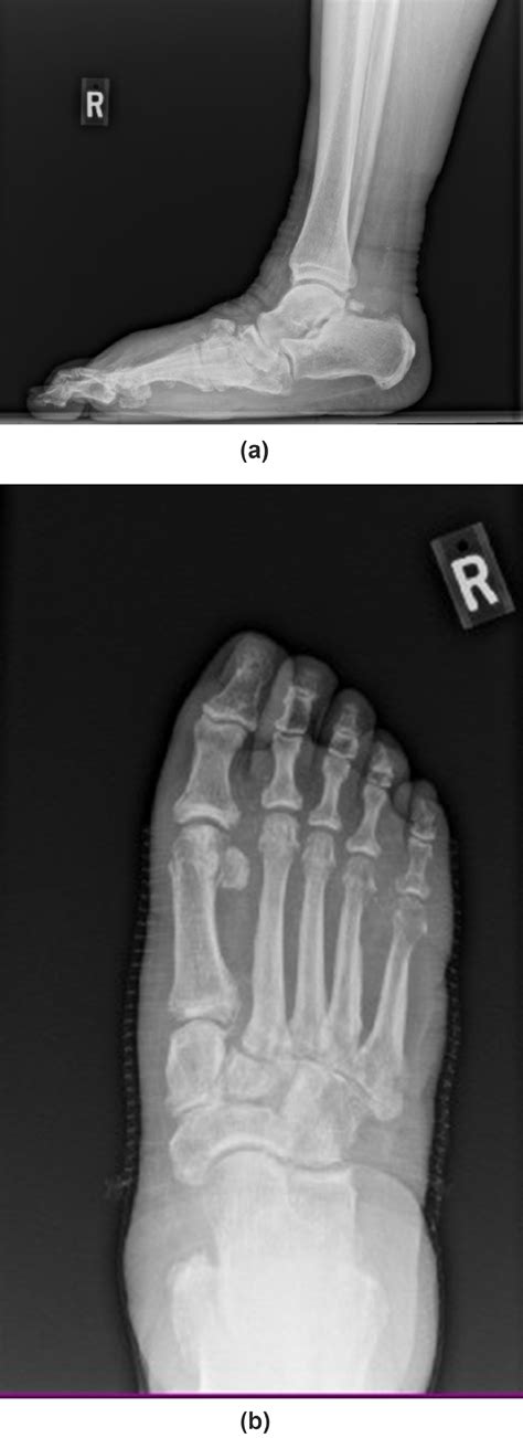 Tibiotalocalcaneal arthrodesis for the treatment of midfoot Charcot neuroarthropathy - Foot ...