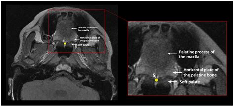 Using Geometric Morphometric Analysis of Magnetic Resonance Imaging to Assess the Anatomy of the ... - length of eustachian tube