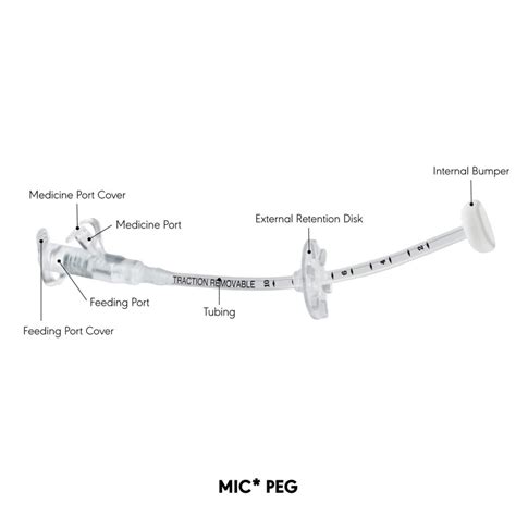 Percutaneous Endoscopic Gastrostomy (PEG) Tubes - TubeFed