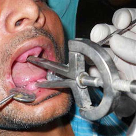 Waldent Heister Mouth Gag (8/112) – Waldent.com