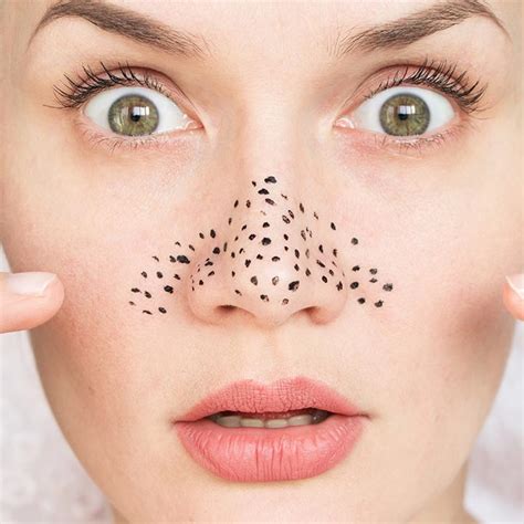 What Is A Blackhead: Causes, Symptoms & Treatments - StarBiz.com
